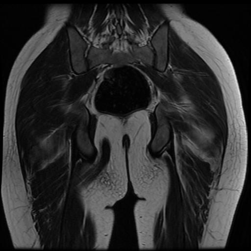 File:Avascular necrosis of the hip (Radiopaedia 29563-30067 Coronal T2 15).jpg
