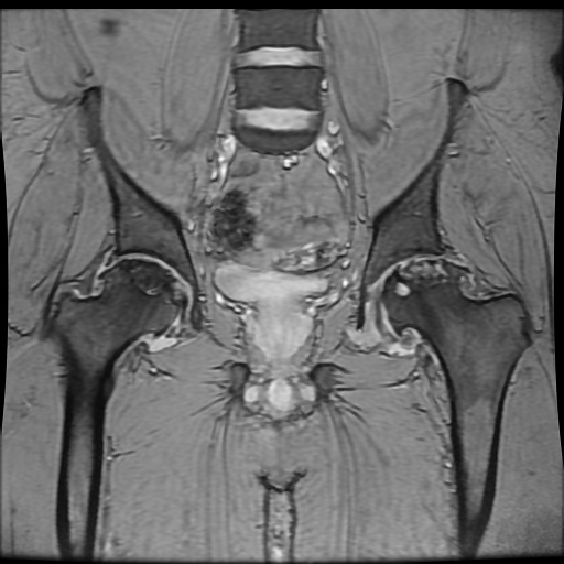 Avascular necrosis of the hip (Radiopaedia 61503-69465 F 48).jpg