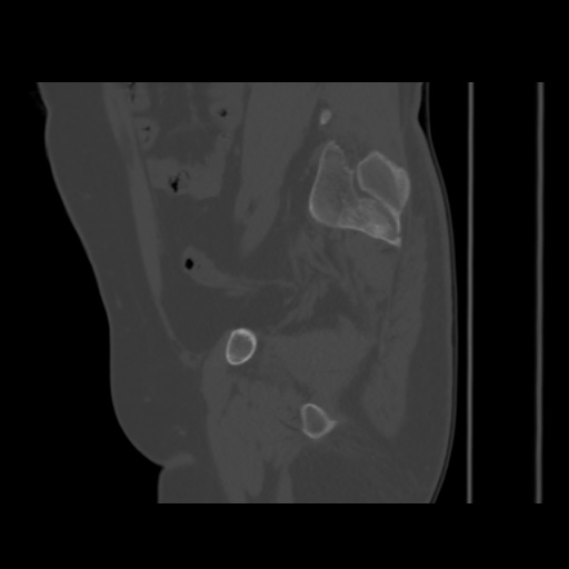 Avascular necrosis of the hip (Radiopaedia 61503-69467 B 39).jpg