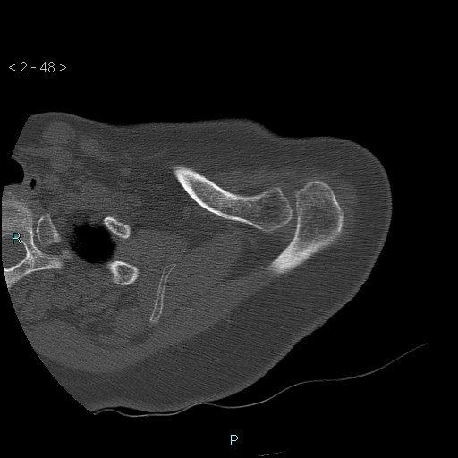 Avascular necrosis of the shoulder - Cruess stage I (Radiopaedia 77674-89887 Axial bone window 12).jpg