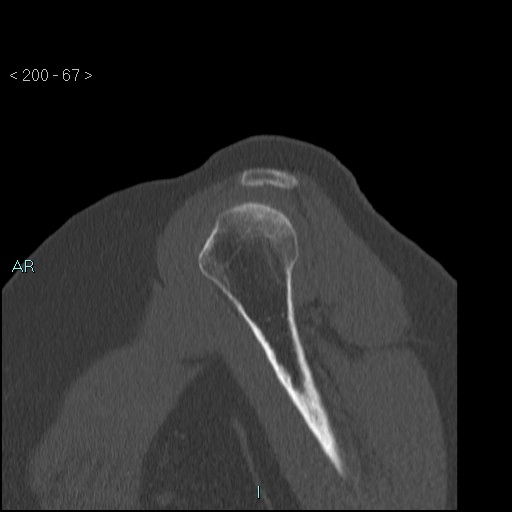 File:Avascular necrosis of the shoulder - Cruess stage I (Radiopaedia 77674-89887 Sagittal bone window 66).jpg