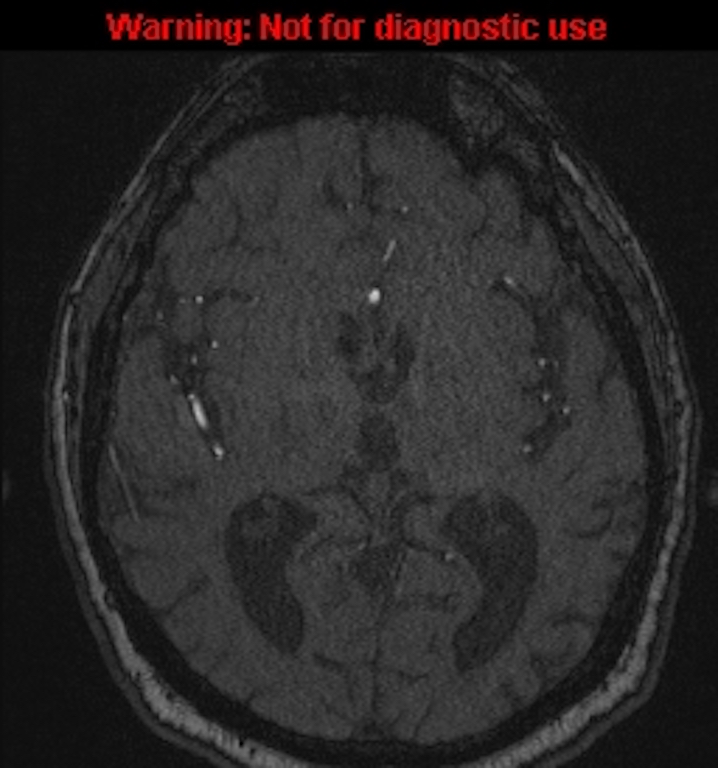 Azygos anterior cerebral artery (Radiopaedia 59325-66677 Axial MRA 87).jpg