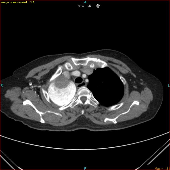Azygos vein aneurysm (Radiopaedia 77824-90130 B 13).jpg