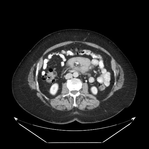 B-cell lymphoma of the mesentery (Radiopaedia 65711-74827 A 64).jpg