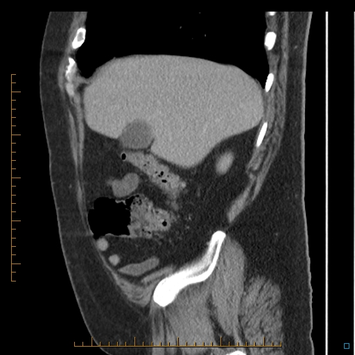 Bariatric balloon causing gastric outlet obstruction (Radiopaedia 54449-60672 C 66).jpg