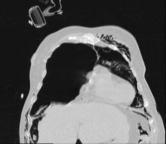 Barotrauma due to mechanical ventilation (Radiopaedia 28079-28336 Coronal lung window 24).jpg