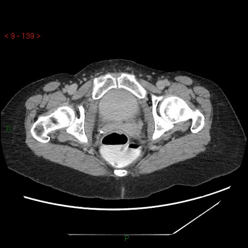 File:Bartholin gland cyst (Radiopaedia 54904-61181 Axial C+ delayed 35).jpg