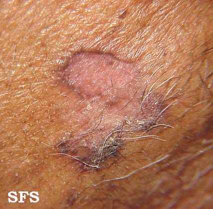 Basal Cell Carcinoma (Dermatology Atlas 24).jpg