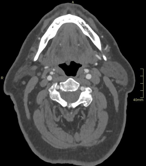 Basilar artery aneurysm (Radiopaedia 56261-62932 A 10).jpg