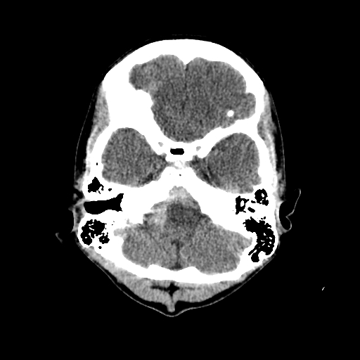 File:Basilar artery perforator aneurysm (Radiopaedia 82455-96597 Axial non-contrast 6).jpg
