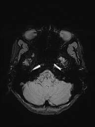 Basilar artery perforator aneurysm (Radiopaedia 82455-97733 Axial SWI 8).jpg