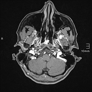 Basilar artery perforator aneurysm (Radiopaedia 82455-99523 G 6).jpg
