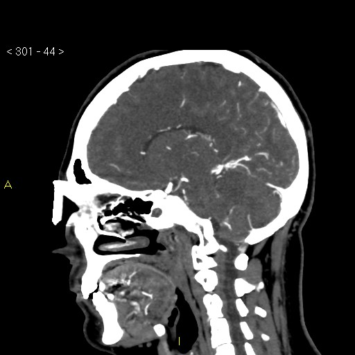 File:Basilar artery thrombosis (Radiopaedia 16260-15944 C 38).jpg