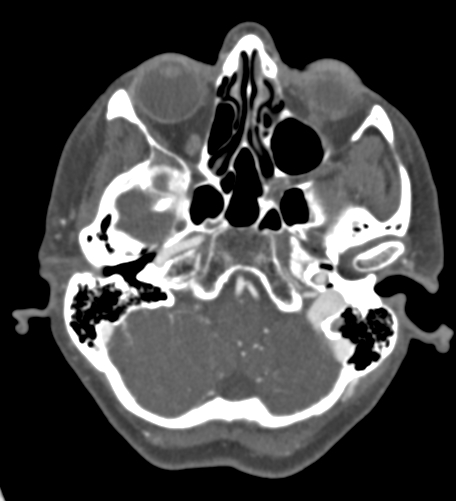 Basilar tip aneurysm with coiling (Radiopaedia 53912-60086 A 31).jpg
