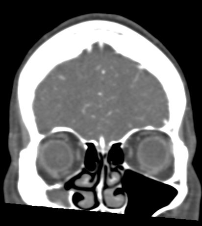 Basilar tip aneurysm with coiling (Radiopaedia 53912-60086 B 21).jpg