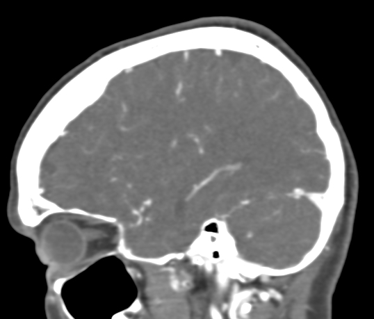Basilar tip aneurysm with coiling (Radiopaedia 53912-60086 C 35).jpg