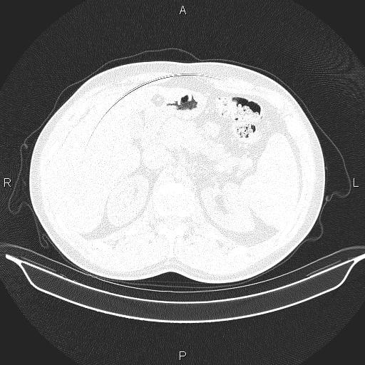 File:Beam hardening and ring artifacts (Radiopaedia 85323-100915 Axial lung window 77).jpg