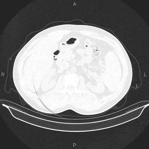 Beam hardening and ring artifacts (Radiopaedia 85323-100915 Axial lung window 82).jpg