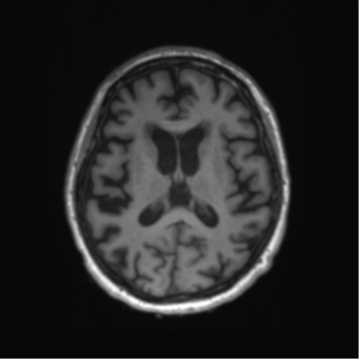 Behavioral variant frontotemporal dementia and late onset schizophrenia (Radiopaedia 52197-58083 Axial T1 42).png