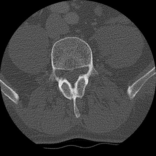 Benign post-traumatic pseudopneumoperitoneum (Radiopaedia 71199-81495 Axial bone window 259).jpg