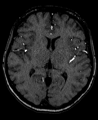 File:Berry aneurysm of the terminal internal carotid artery (Radiopaedia 88286-104918 Axial TOF 131).jpg