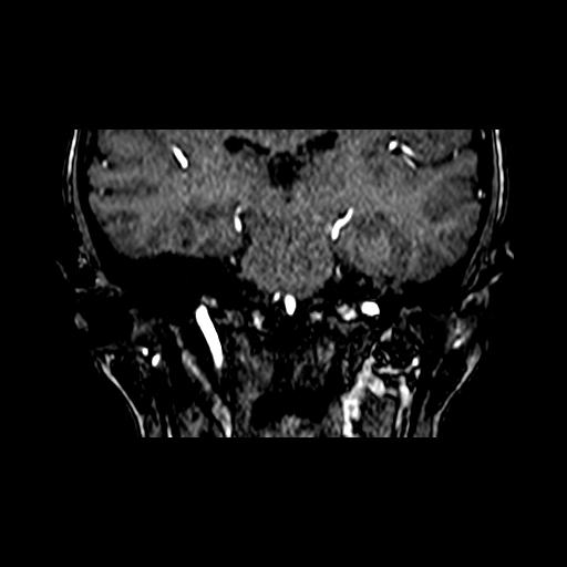 File:Berry aneurysm of the terminal internal carotid artery (Radiopaedia 88286-104918 Coronal TOF 59).jpg
