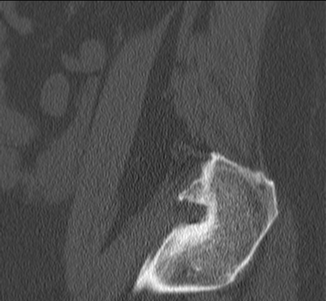 Bertolotti syndrome (Radiopaedia 24864-25128 Sagittal bone window 5).jpg