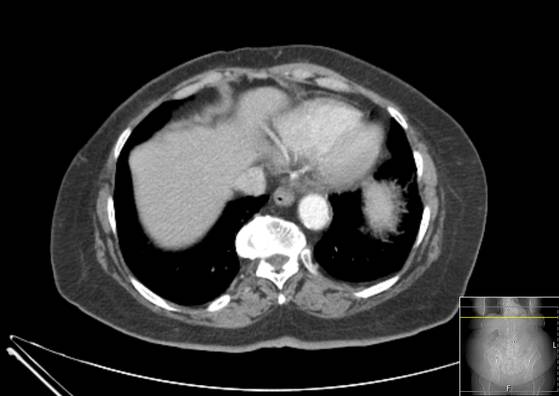 Bicameral celiacomesenteric aneurysm (Radiopaedia 55766-62327 A 4).jpg