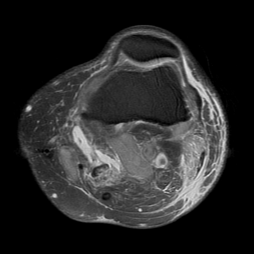 File:Biceps femoris distal tendon avulsion (Radiopaedia 15109-14987 Axial PD fat sat 6).jpg