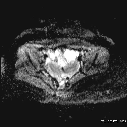 File:Bicornuate uterus- on MRI (Radiopaedia 49206-54297 Axial ADC 13).jpg