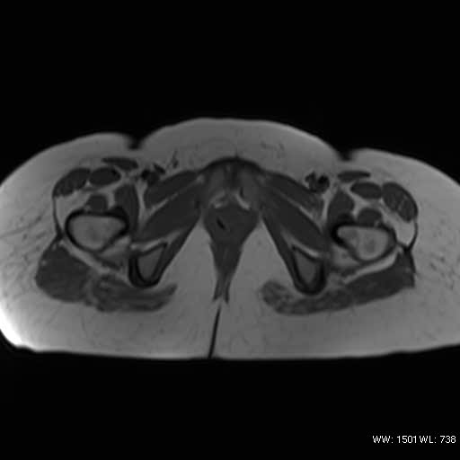 File:Bicornuate uterus- on MRI (Radiopaedia 49206-54297 Axial T1 16).jpg