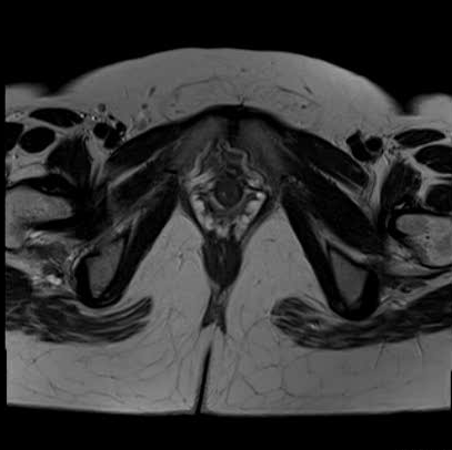 File:Bicornuate uterus (MRI) (Radiopaedia 49206-54297 Axial 38).png