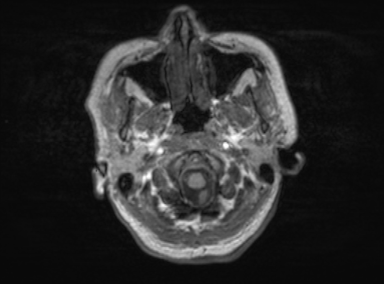 File:Bilateral PCA territory infarction - different ages (Radiopaedia 46200-51784 Axial T1 349).jpg