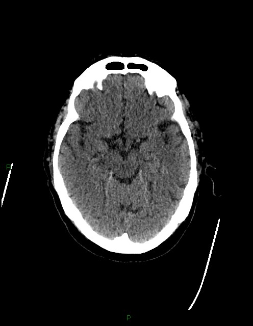 Bilateral acute middle cerebral artery territory infarcts (Radiopaedia 77319-89401 Axial non-contrast 34).jpg