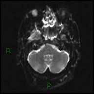 File:Bilateral acute middle cerebral artery territory infarcts (Radiopaedia 77319-89402 Axial DWI 6).jpg