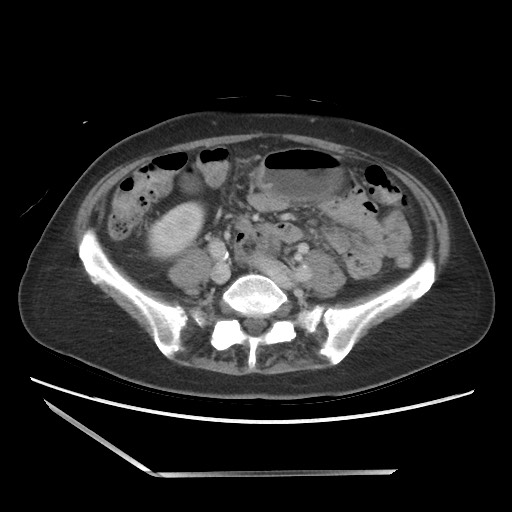 Bilateral adrenal granulocytic sarcomas (chloromas) (Radiopaedia 78375-91007 A 76).jpg