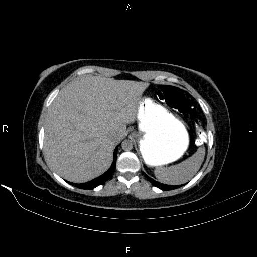 Bilateral adrenal myelolipoma (Radiopaedia 63058-71535 Axial non-contrast 28).jpg