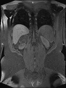 Bilateral adrenal myelolipoma (Radiopaedia 63058-71537 Coronal T1 fat sat 23).jpg