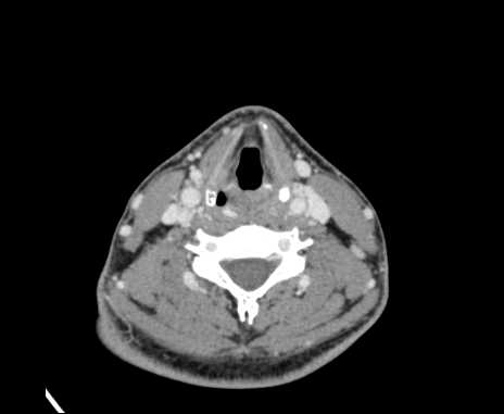 Bilateral carotid body tumors (Radiopaedia 61841-69870 Axial Post contrast 69).jpg