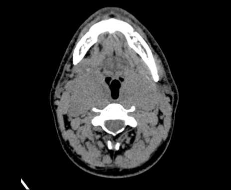 File:Bilateral carotid body tumors (Radiopaedia 61841-69870 Axial non-contrast 44).jpg