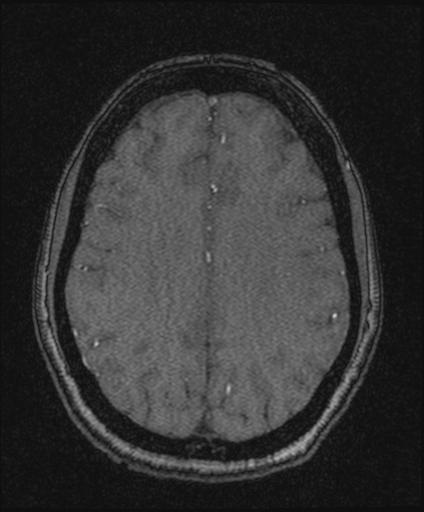 Bilateral carotid body tumors and right glomus jugulare tumor (Radiopaedia 20024-20060 Axial MRA 129).jpg