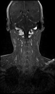 Bilateral carotid body tumors and right glomus jugulare tumor (Radiopaedia 20024-20060 MRA 55).jpg