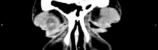 File:Bilateral enlargement of lacrimal glands - sarcoidosis (Radiopaedia 62627-70921 Coronal non-contrast 6).jpg