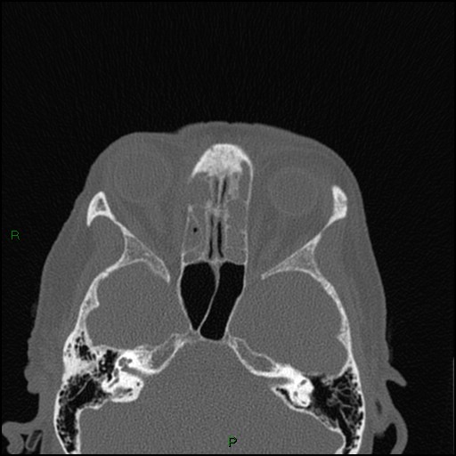 Bilateral frontal mucoceles (Radiopaedia 82352-96454 Axial bone window 139).jpg