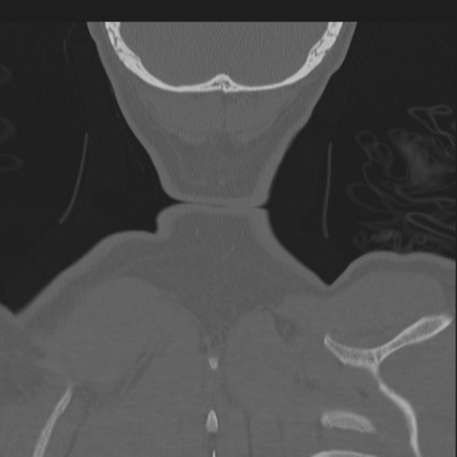Bilateral locked facets (Radiopaedia 33850-35016 Coronal bone window 89).png