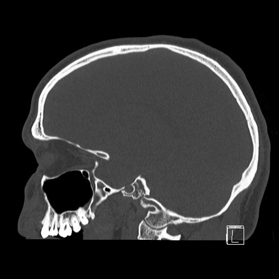 Bilateral occipital condyle fracture (type 2) (Radiopaedia 87675-104089 Sagittal bone window 37).jpg
