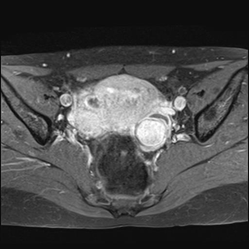 File:Bilateral ovarian endometriomas (Radiopaedia 87085-103347 Axial T1 C+ fat sat 10).jpg