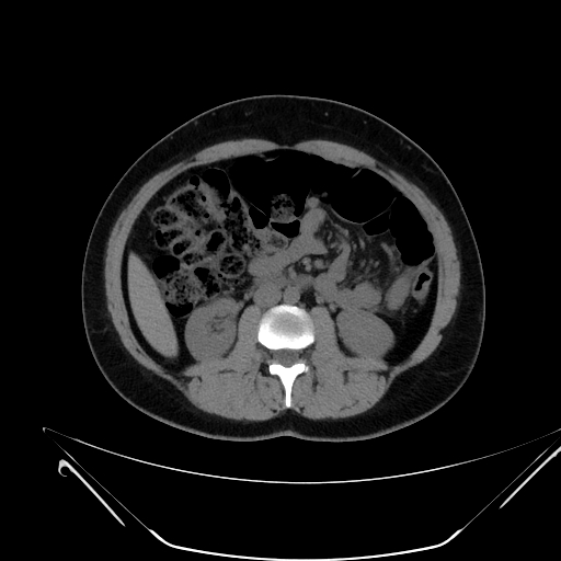 File:Bilateral ovarian mature cystic teratomas (Radiopaedia 79373-92457 Axial non-contrast 29).jpg