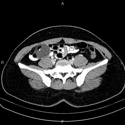 Bilateral ovarian teratoma (Radiopaedia 83131-97503 Axial With contrast 17).jpg