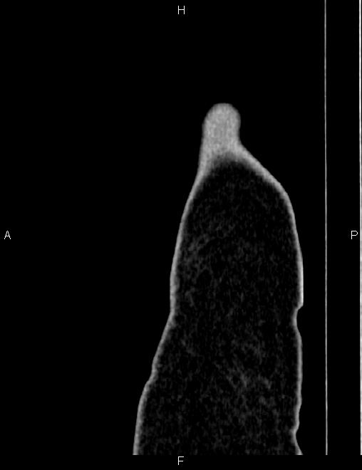 Bilateral ovarian teratoma (Radiopaedia 83131-97503 D 6).jpg